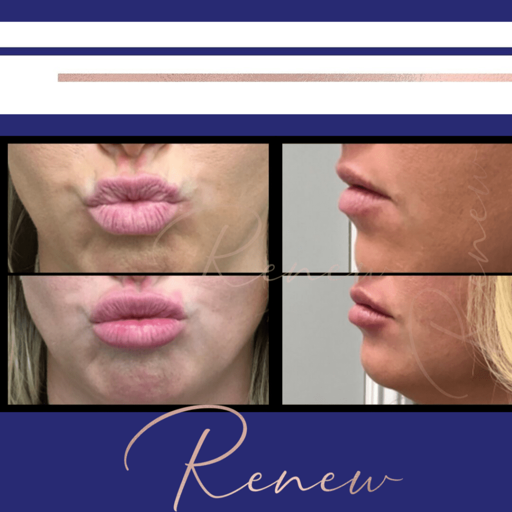Lip filler pre post