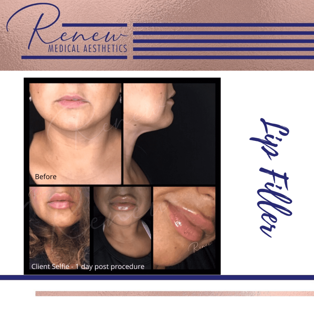 lip filler