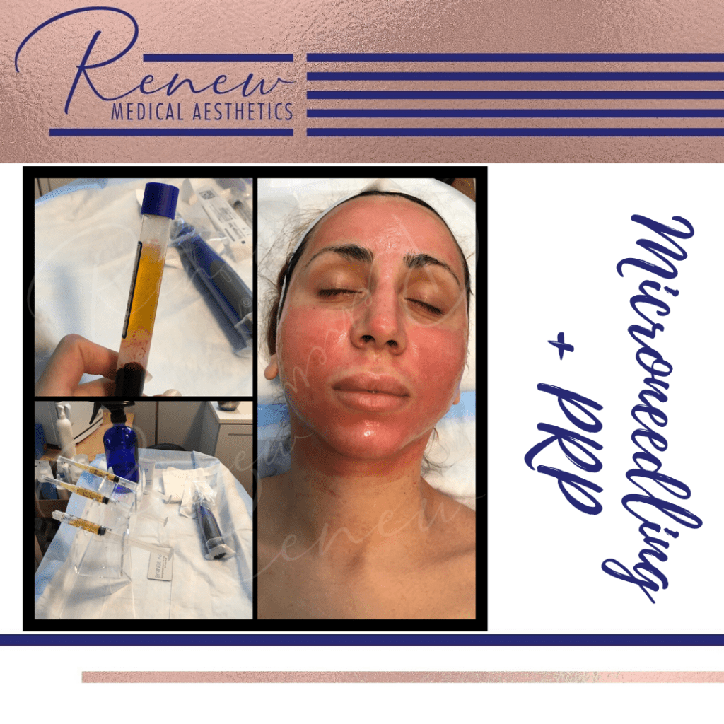 Microneedling + PRP
