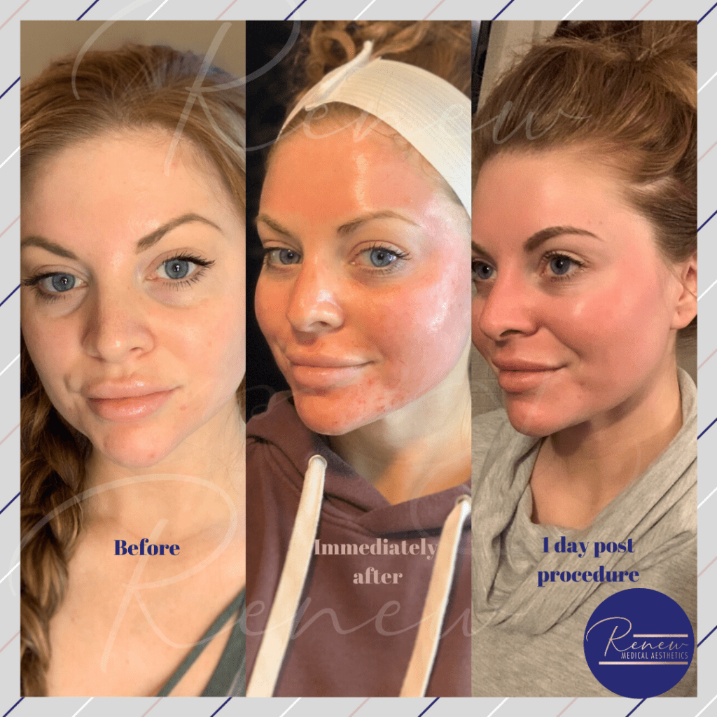 Frankie microneedling renew