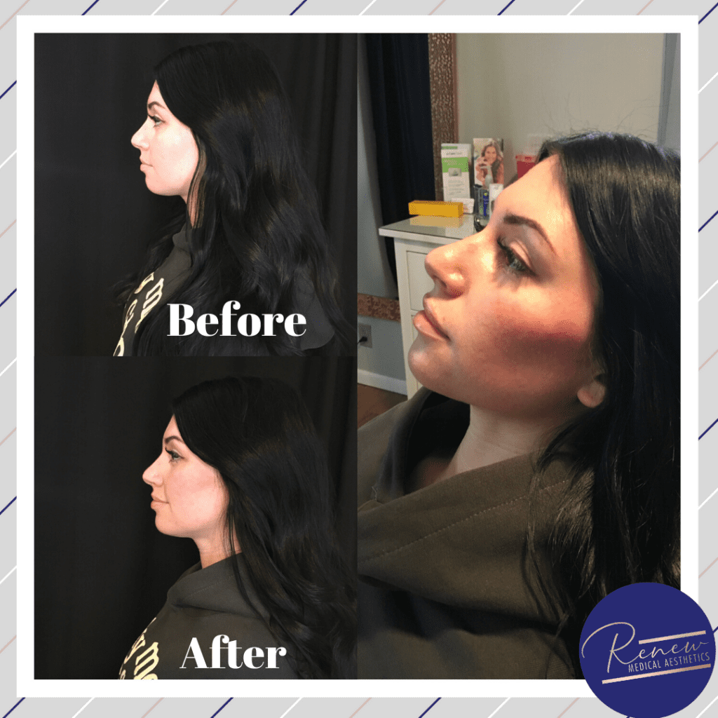 cheek filler