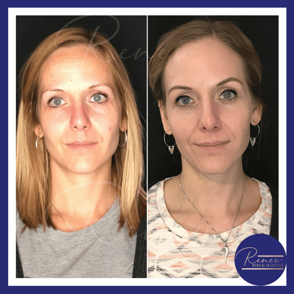 full face skincare and dysport