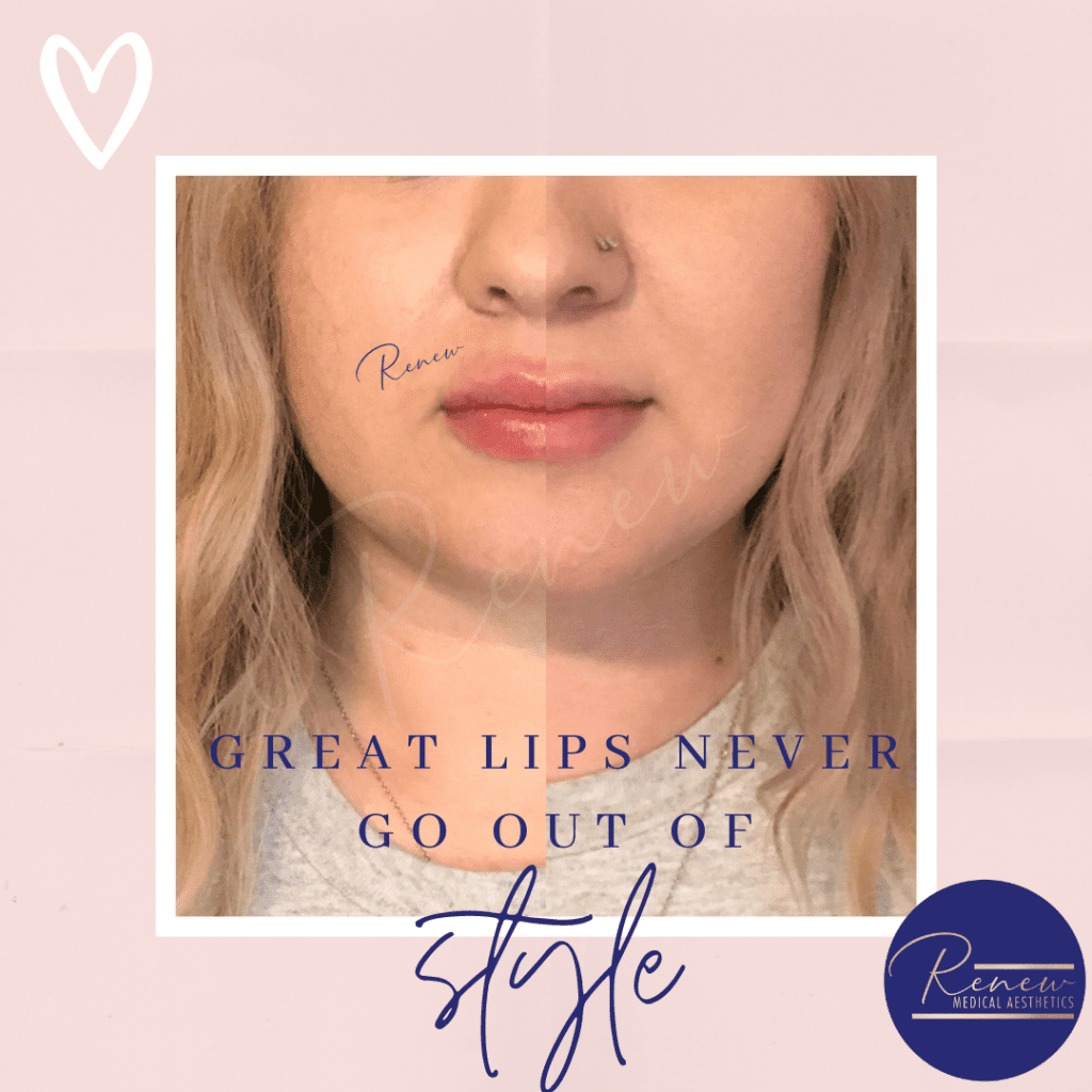 lip filler