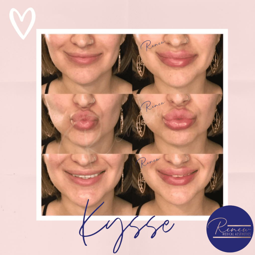 lip filler