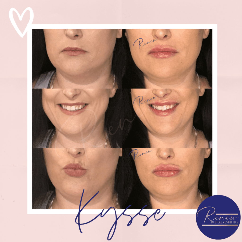 lip filler