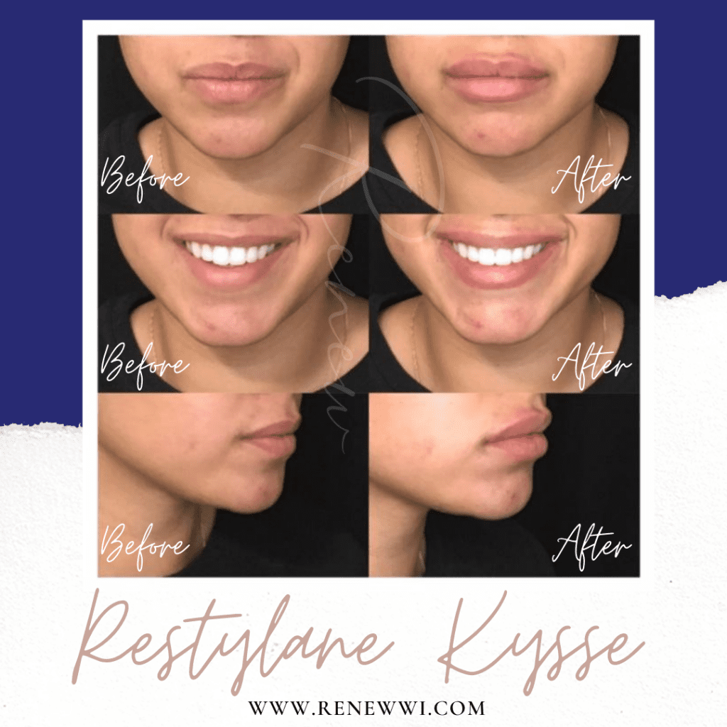 lip filler
