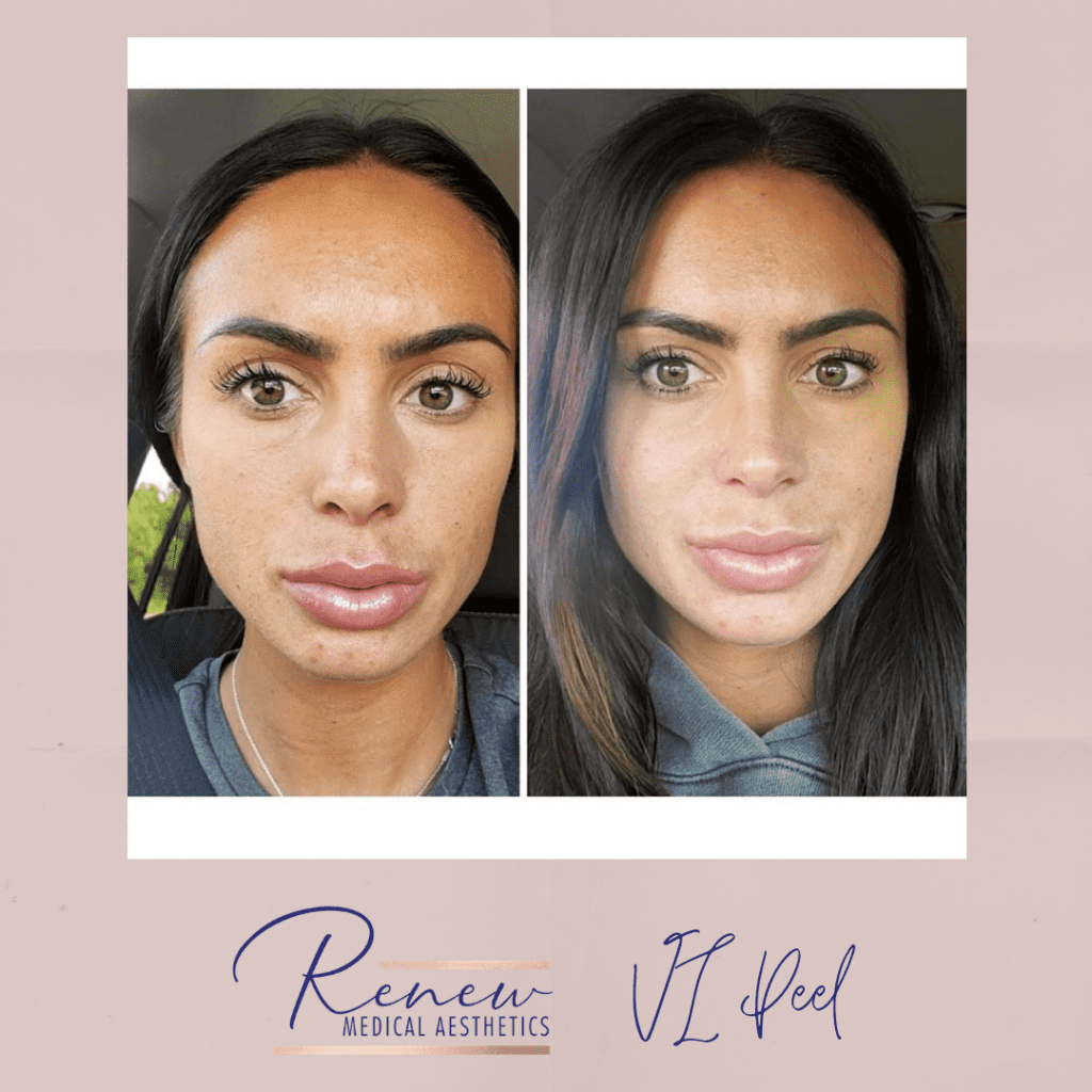 VI Peel Purify with Precision Plus (1)
