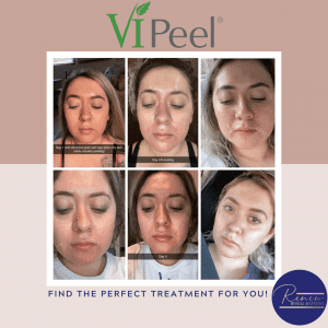 chemical peel