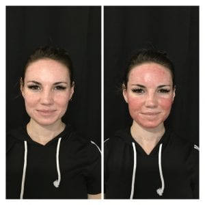 microneedling