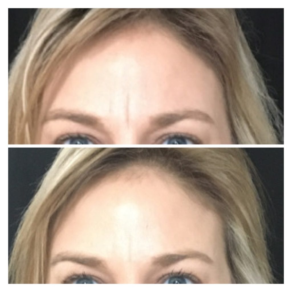 Dysport at rest Renew Medical Aesthetics WI