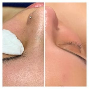 extractions facial