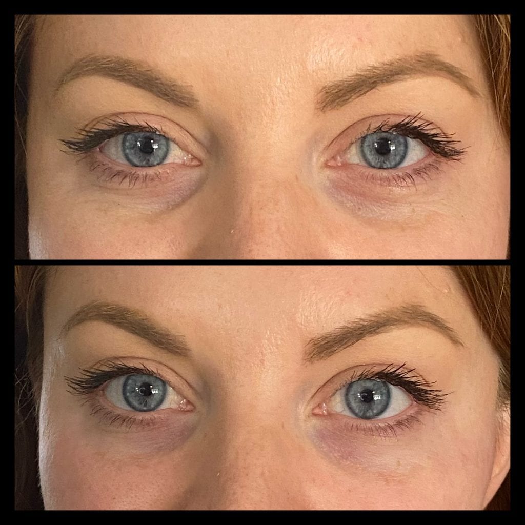 tear trough filler under eye filler