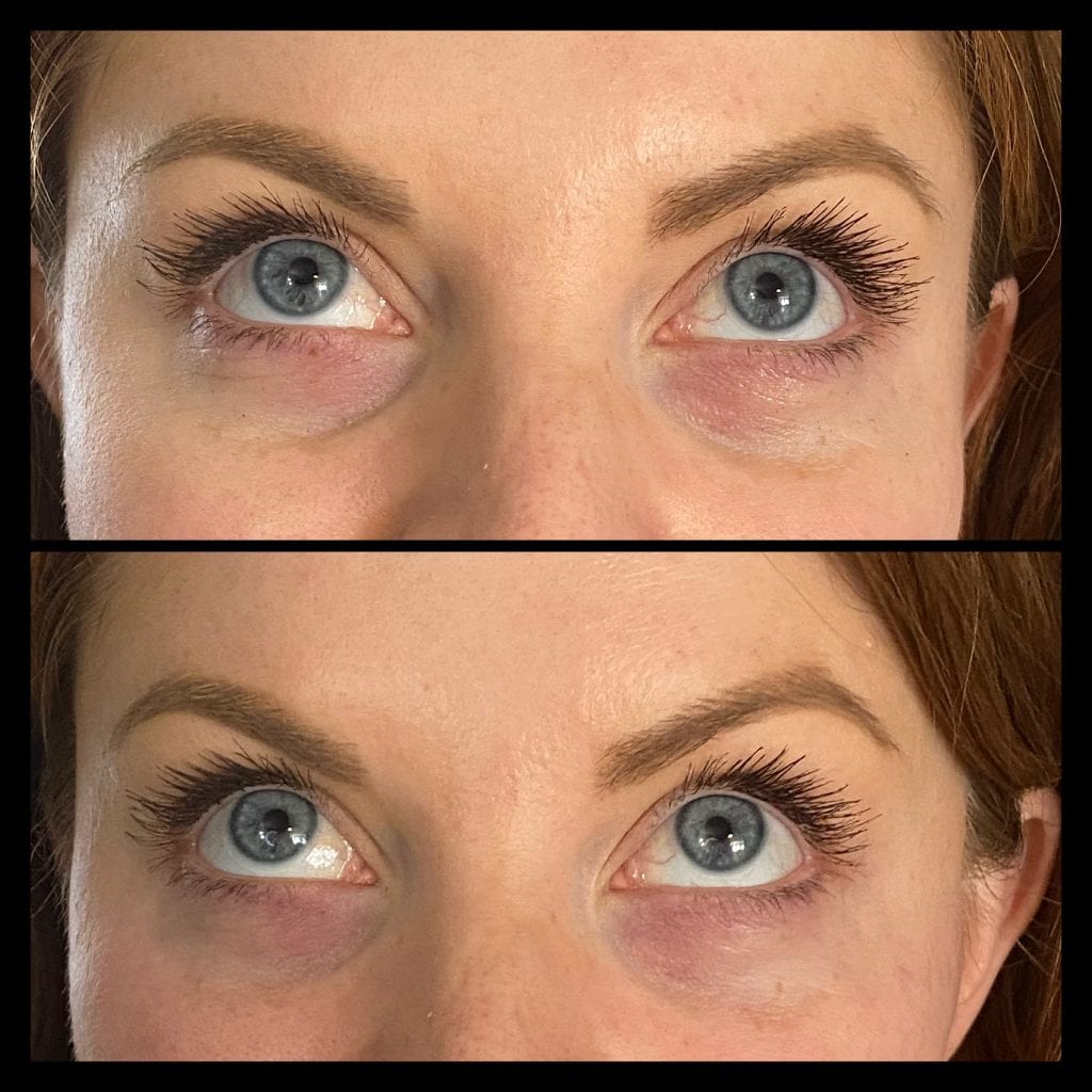 tear trough filler under eye filler
