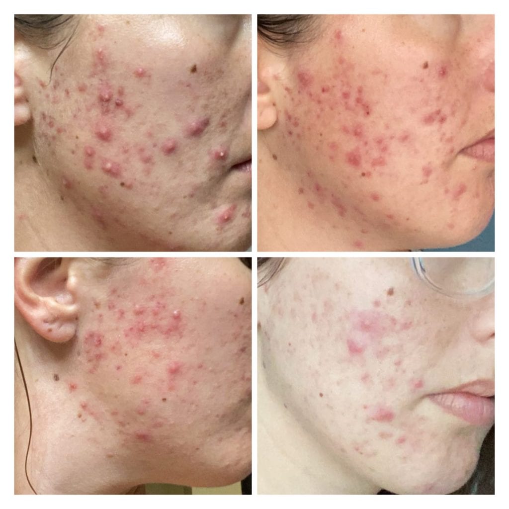VI Peel microneedling acne