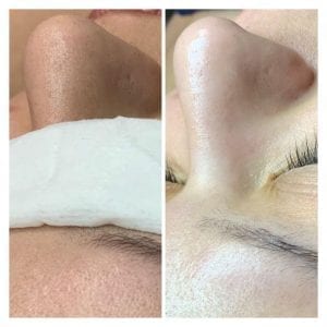 facial