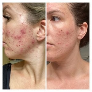 Acne progress