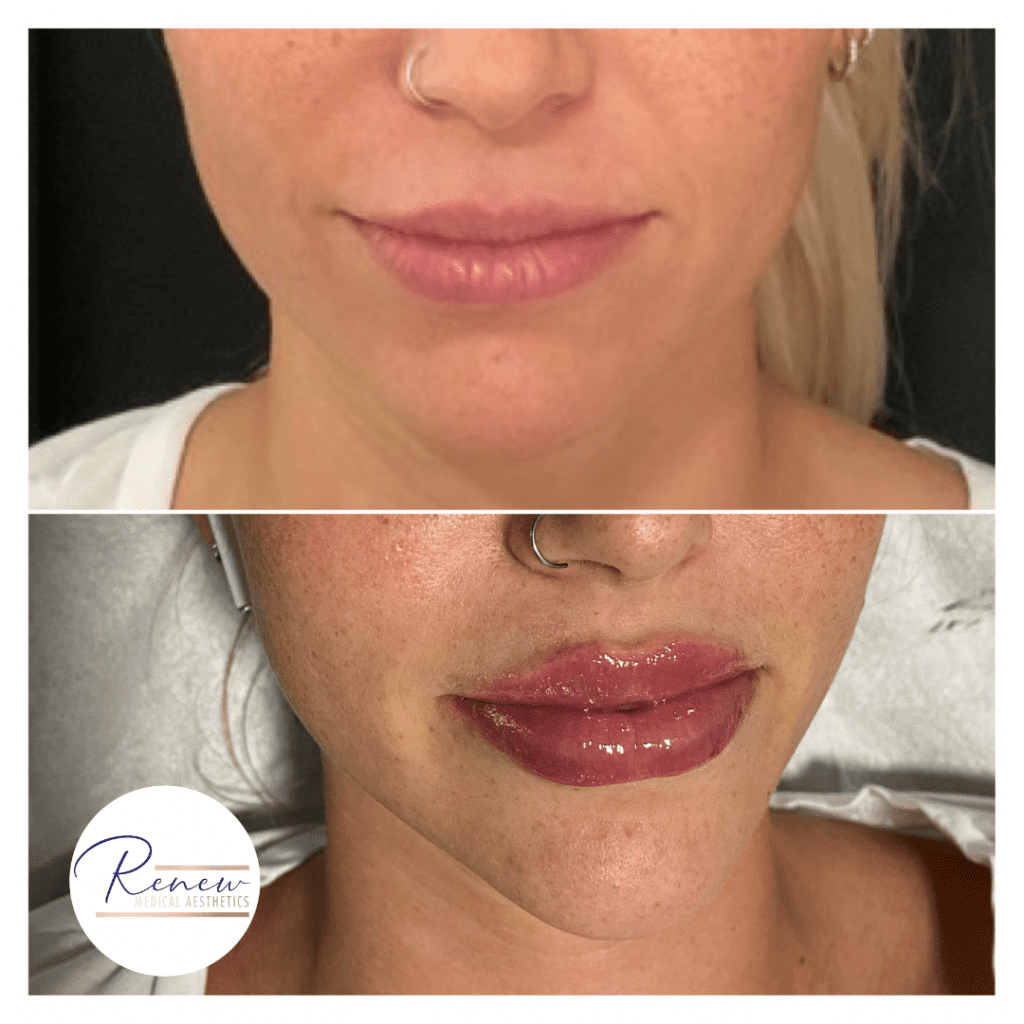 Lip Filler