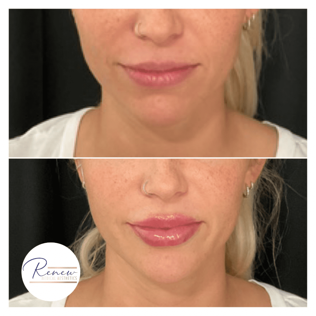 Lip Filler