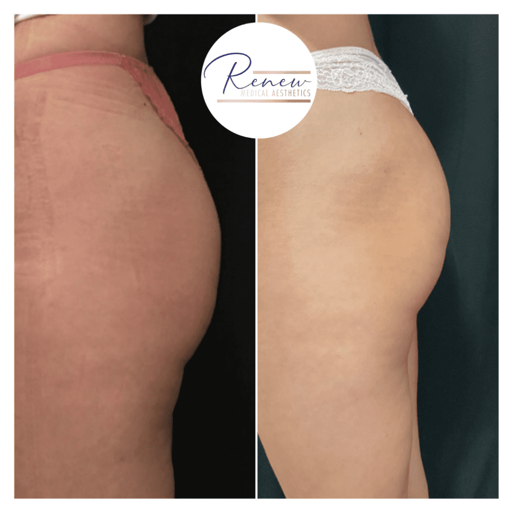 sculptra booty