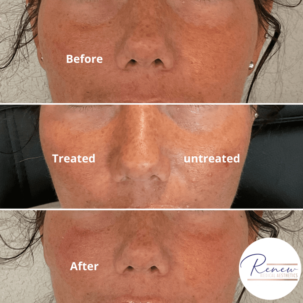 year trough filler under eye filler