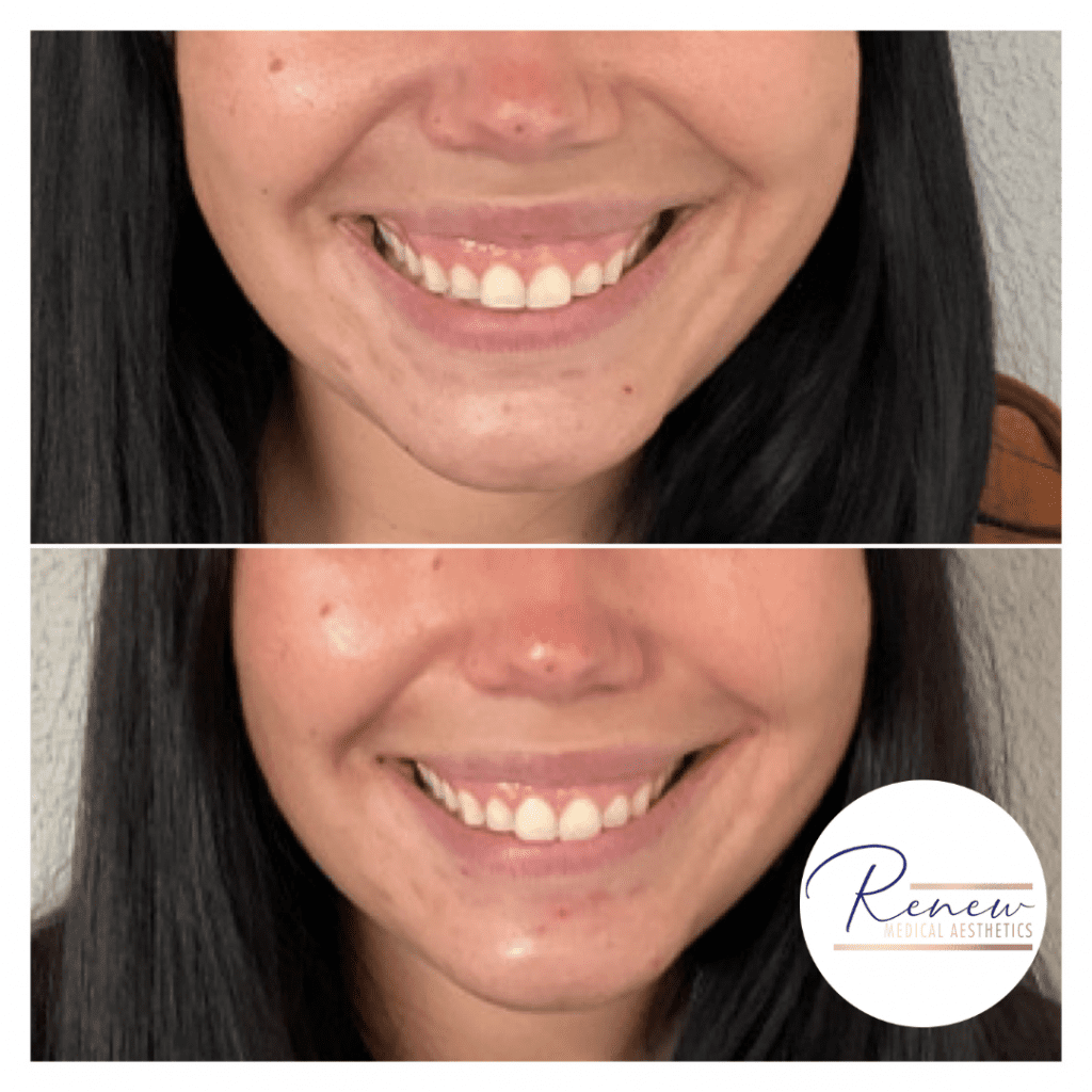 Dysport gummy smile