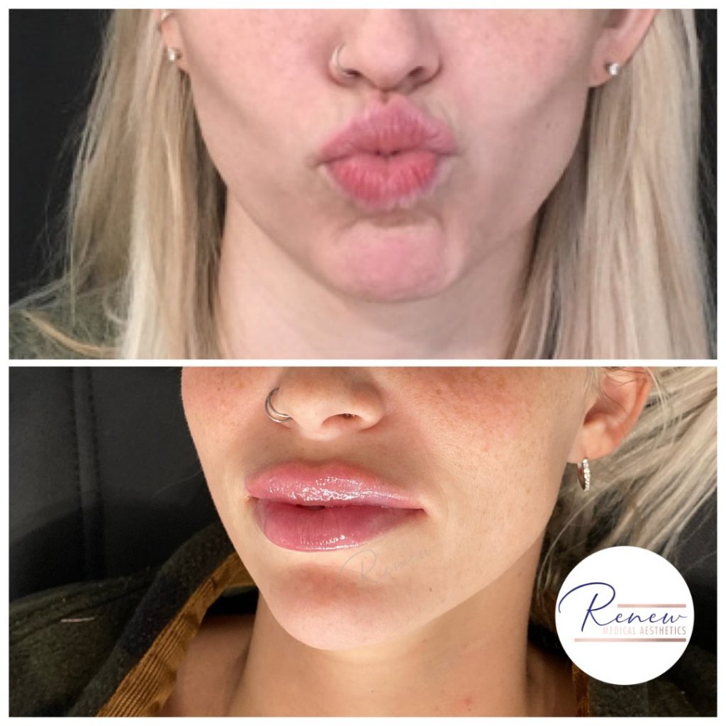 Lip building minis of kysse 3
