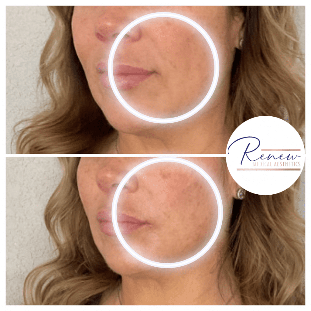 sculptra progression