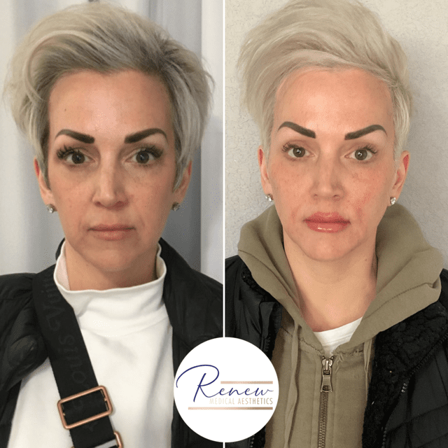 sculptra dermal filler combo