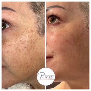 BBL IPL face pigmentation sun damage