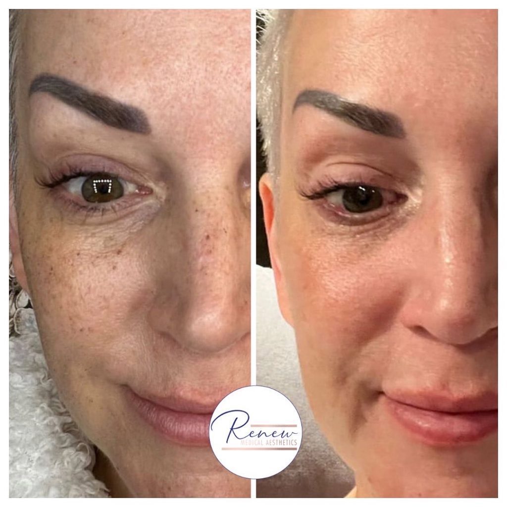 BBL IPL face pigmentation sun damage