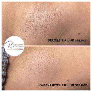 laser hair removal LHR