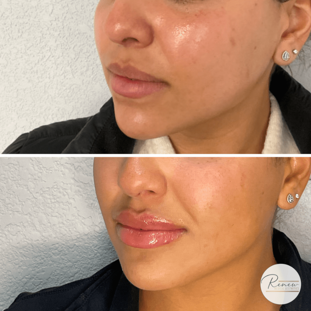 lip filler correction