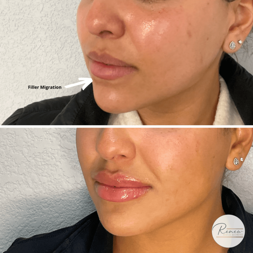 lip filler correction
