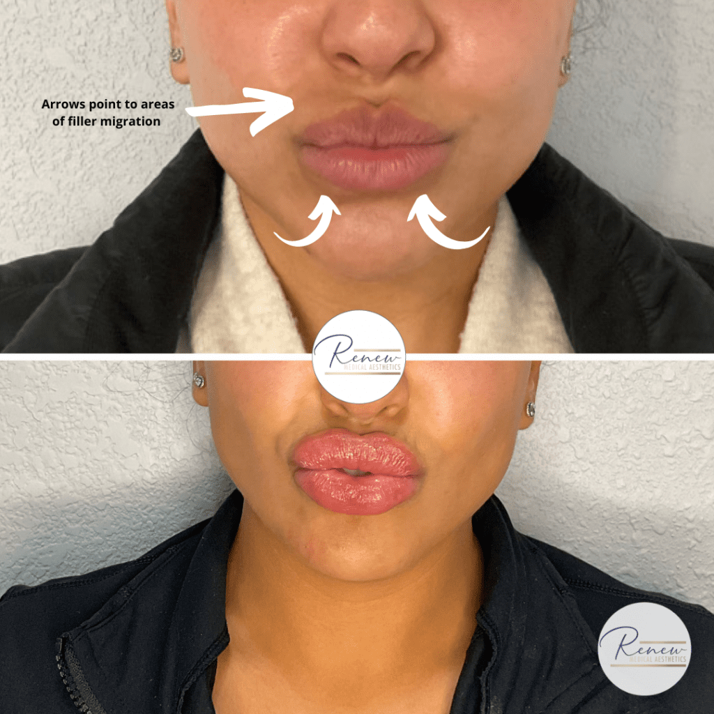 lip filler correction