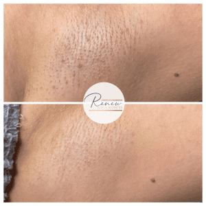 under arm laser hair removal