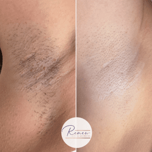 Laser hair removal underarms 3