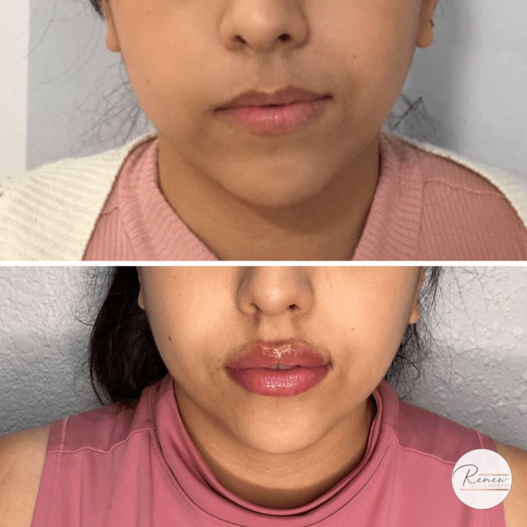 Lip Filler not an overnight process 1