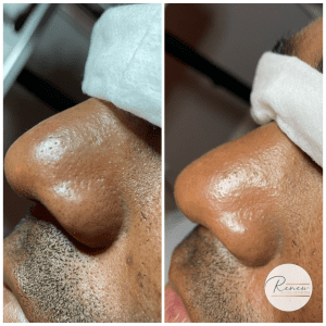 facial 2