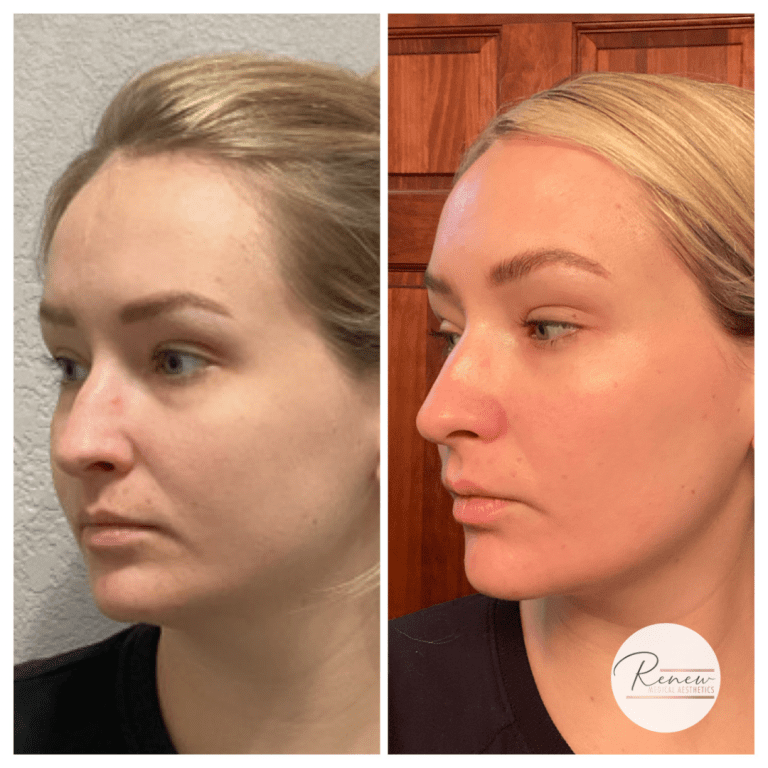 MOXI before and after