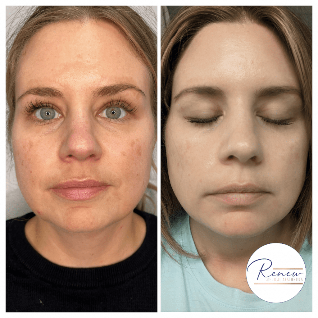 MOXI melasma