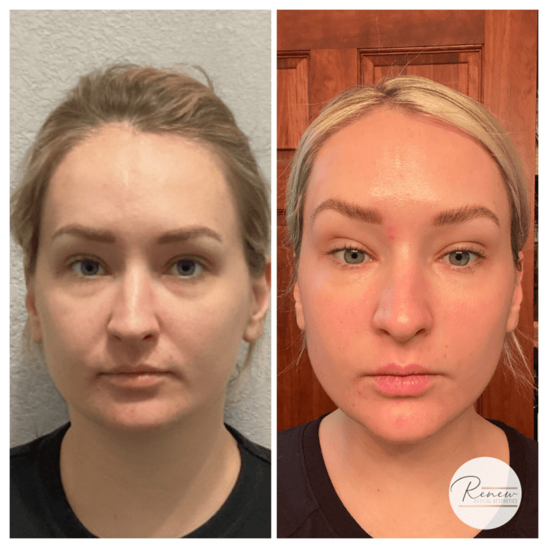 MOXI before and after