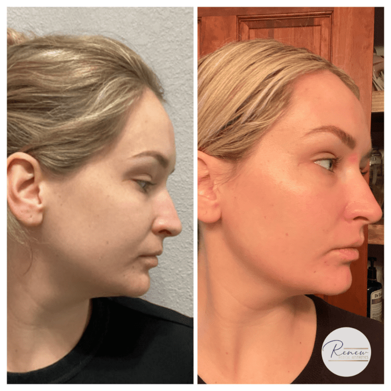 MOXI before and after