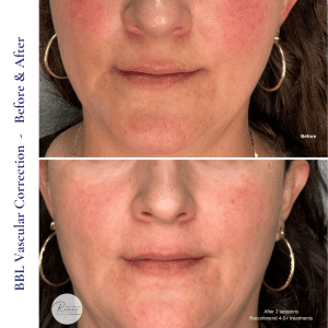 BBL Vascular Correction (3)