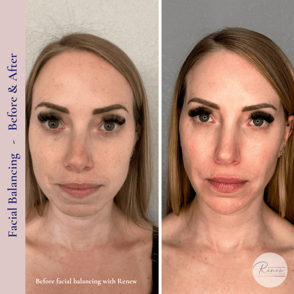 full face balancing with dermal filler