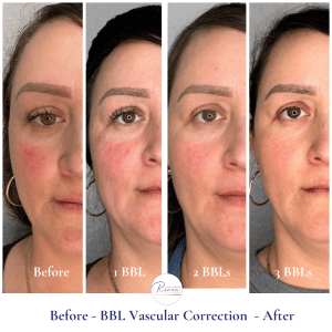 BBL Vascular Correction