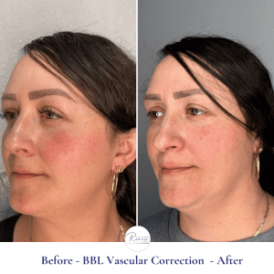 BBL Vascular Correction (4)