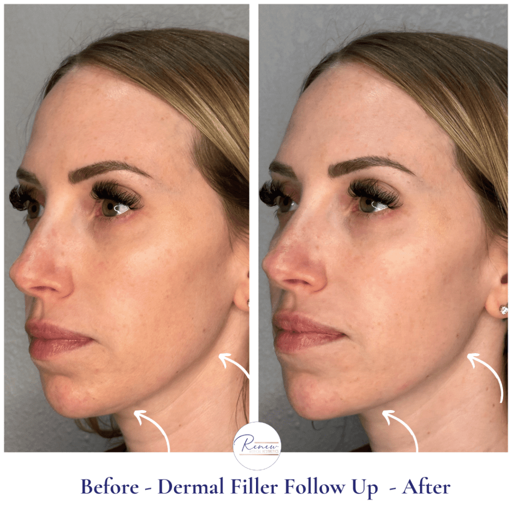 Dermal Fillers - Renew Medical Aesthetics