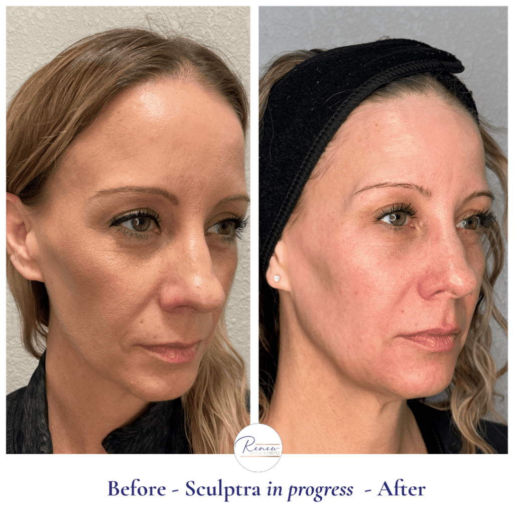 Sculptra
